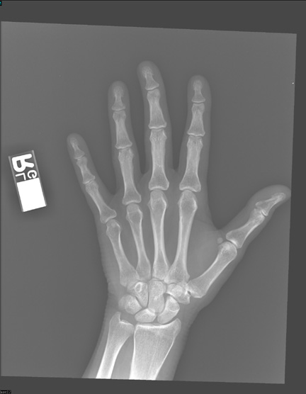 hand x-ray