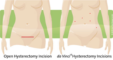 Hysteroctomay