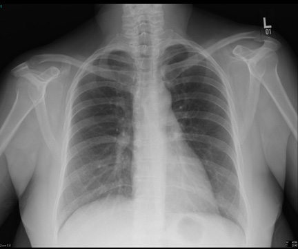 chest x-ray