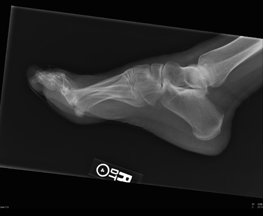 foot x-ray