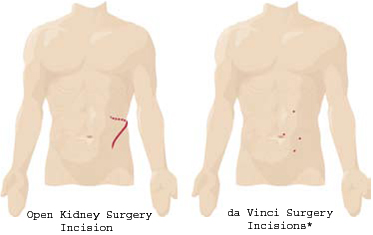kidney_vinci_surgery