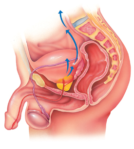 prostatecancer