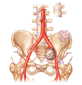 spinetumor